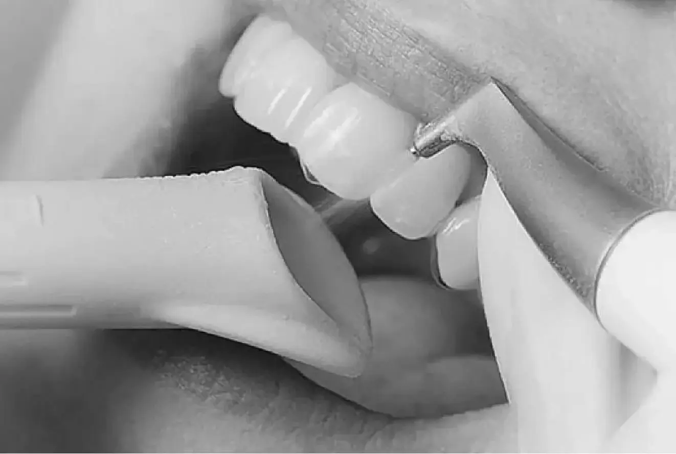 Close-up of Air Flow teeth cleaning, showing tools and bright teeth, highlighting effective stain removal and oral health.