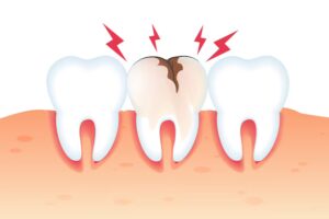 a painful cracked and damaged tooth in the center, with red lightning symbols indicating tooth pain.